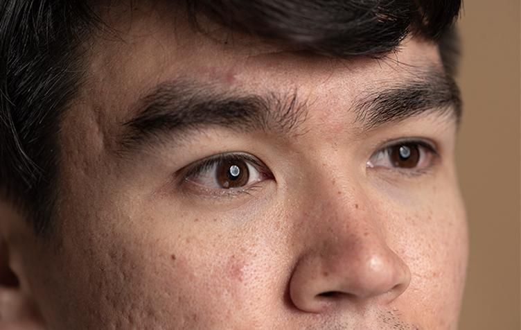 Dark Spot Reductio