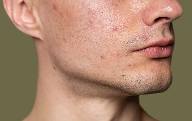 Pigmentation Removal