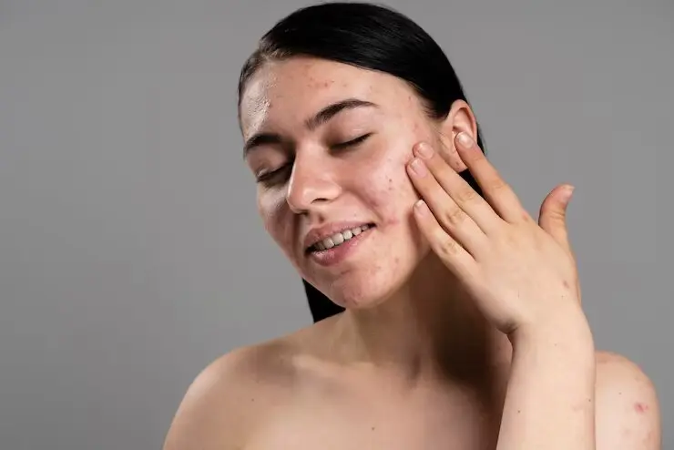 Which Face Wash is Best for Oily Skin